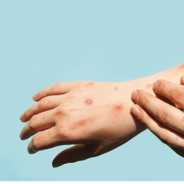 monkeypox spreading with disinfectants