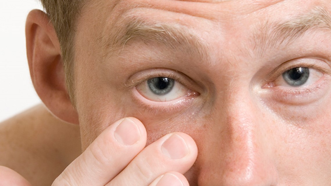 Conjunctivitus